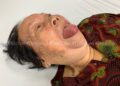 Case Lâm Sàng : Trường Hợp Phù Mạch Tích Lũy Bradykinin Do Dùng Thuốc Hạ Áp Nhóm Ức Chế Thụ Thể Angiotensin (ARB) Losartan 50mg